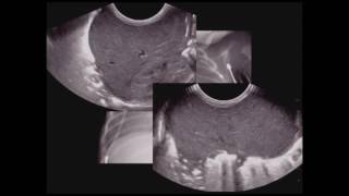 Pediatric Chest Ultrasound [upl. by Wren]