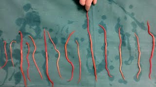 Doctors Remove 14 Roundworms From Woman [upl. by Hairym]