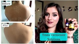 Tinea Versicolor SOLUTIONS TNBeauty94 [upl. by Mauve536]