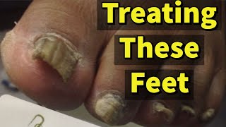 Treating These Feet A Patient With Fungal Toenails [upl. by Katzman]