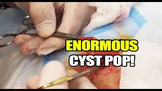 Enormous Cyst Removal Dr Gilmores Biggest Cysts [upl. by Gnilsia248]