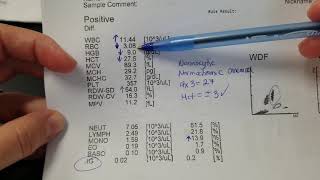 Hematology How to interpret automated Complete Blood Count CBC results [upl. by Hege]