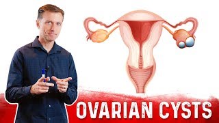 Ovarian Cysts Causes Symptoms amp Natural Treatment – DrBerg [upl. by Aneahs]