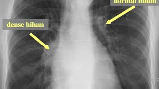 Cervical Lymph Node Levels in 5 minutes [upl. by Benn]