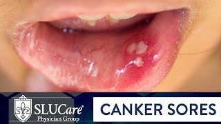 Determining Causes amp Treatment for Canker Sores  SLUCare Otolaryngology [upl. by Garaway]