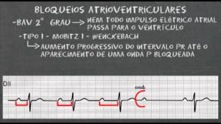 Bloqueios atrioventriculares no eletrocardiograma [upl. by Naji]