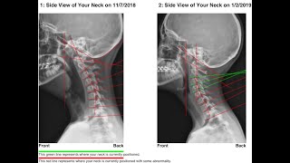 How To Correct Forward Head Posture and Cervical Lordosis With The Cervical Vibratory Traction [upl. by Roti756]