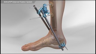 ArthroFX® External Fixation System [upl. by Mose]