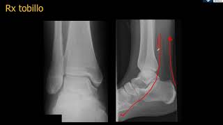 Anatomía Rx Tobillo [upl. by Jelks]