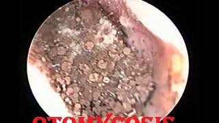 Severe fungal infection  Otomycosis ear cleaning [upl. by Artaed821]