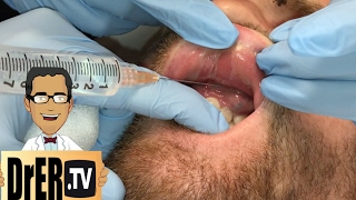 gum abscess drainage  Full VIDEO [upl. by Matrona180]