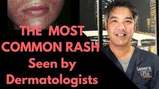 How to treat Perioral Dermatitis Dermatologist Explains [upl. by Frayda]