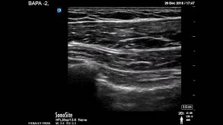 Pectoral muscles scanning [upl. by Htebazileyram]