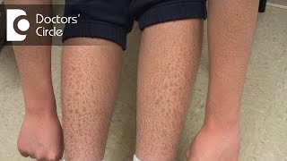 How to manage Ichthyosis Vulgaris in teenage boys  Dr Nischal K [upl. by Llenna]