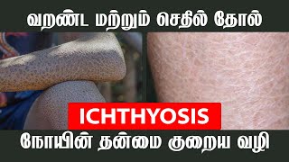 ICHTHYOSIS நோயின் தன்மை குறைய வழி  JKT SKIN [upl. by Levitt59]