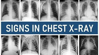 Signs in Chest Xray [upl. by Sewellyn]