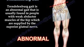 Trendelenburg Gait  Everything You Need To Know  Dr Nabil Ebraheim [upl. by Sueaddaht405]