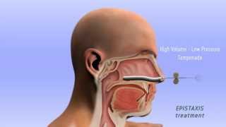 Epistaxis Treatment  3D [upl. by Aitam40]