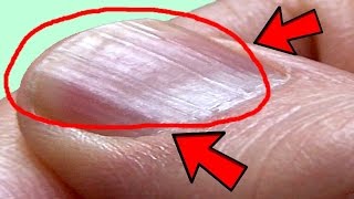 What Causes Ridges in Finger and Toenails [upl. by Narrad]