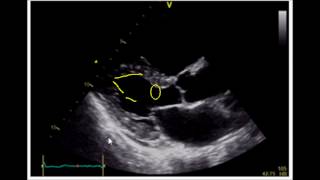 Estimating Ejection Fraction with Point of Care Echo [upl. by Auqinimod215]