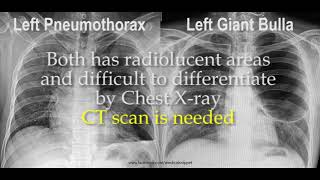 Pneumothorax vs Bulla in Chest X ray [upl. by Amuh]