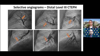 How to perform a Balloon Pulmonary Angioplasty BPA [upl. by Rebor]