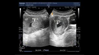 Ultrasound Video showing Incomplete abortion [upl. by Leisam]