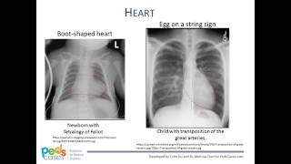 Approach to Pediatric Chest XRays [upl. by Krista980]