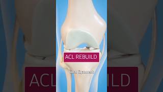 3 Must Do ACL Rehab Exercises [upl. by Nawad286]