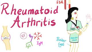 Rheumatoid arthritis Part 5 Atlantoaxial instability subluxation [upl. by Ruberta388]