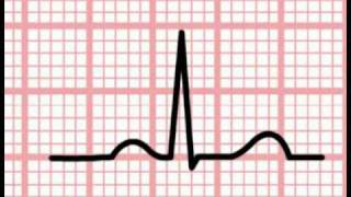 ECG Interpretation  Time and the ECG Section 1 Part 5 [upl. by Refeinnej]