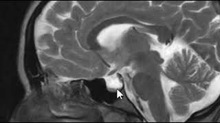 Pseudotumor Cerebri  Brain Scan MRI [upl. by Nylrak186]