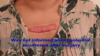 Chest Keloids  Mistakes to Avoid [upl. by Madid104]