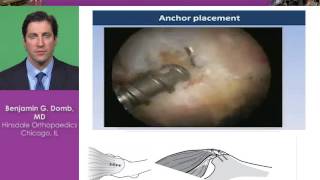 Gluteus Medius Tears Techniques and Indications [upl. by Einimod525]