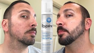 How to grow a REAL Beard  Minoxidil 4 Month Beard Journey [upl. by Syverson]