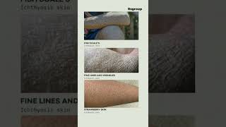 Ichthyosis Treatment Effective Solutions for Skin Condition  Your Guide to Treating Ichthyosis [upl. by Perusse310]