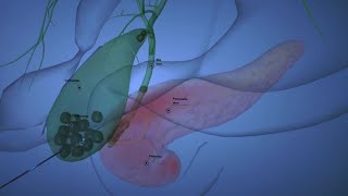 Causes of Gallstone Pancreatitis [upl. by Aicirtac234]