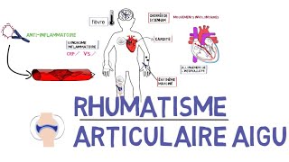 Rhumatisme articulaire aigu RAAde A à Z [upl. by Fritze]