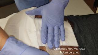 Change Dressing Pilonidal Abscess Wound at Home [upl. by Ayiram216]