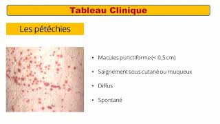 Purpura Thrombopenique Immunologique PTI [upl. by Drehcir]