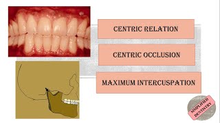 Centric Relation  Centric Occlusion  Maximum Intercuspation [upl. by Isleen]