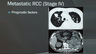 Renal Cell Carcinoma [upl. by Yelyk]