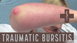 traumatic bursitis [upl. by Francine312]