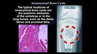 Aneurysmal Bone Cyst  Everything You Need To Know  Dr Nabil Ebraheim [upl. by Ylremik]