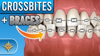 How Do BRACES Fix Crossbites [upl. by Feingold21]