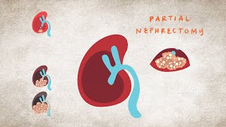 Neoplasia Nomenclature  Benign Tumors  Adenoma  Papilloma [upl. by Chuch129]