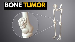 Neoplasia diferenciando lo benigno de lo maligno [upl. by Ahseiyn]