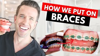 How Braces are Put On  Part IV Dr Nate [upl. by Tnahsarp]