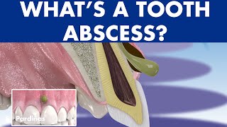 TOOTH ABSCESS dental infection  PHLEGMON symptoms and treatment © [upl. by Sualkcin]