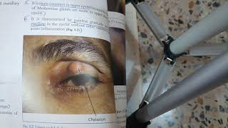 EYELIDS lecture 2 CHALAZION and HORDOLEUM in easiest way with all important things [upl. by Nesyaj]